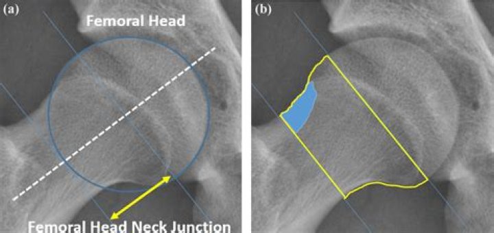 What is femoral neck BMD?
