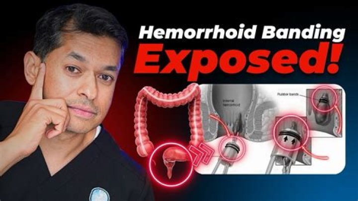 What is hemorrhoid banding and does it work?