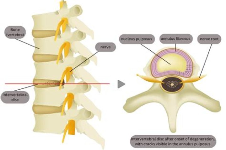 What is meant by herniation of nucleus pulposus?