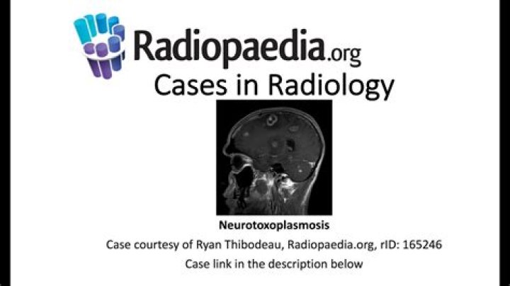What is Neurotoxoplasmosis?