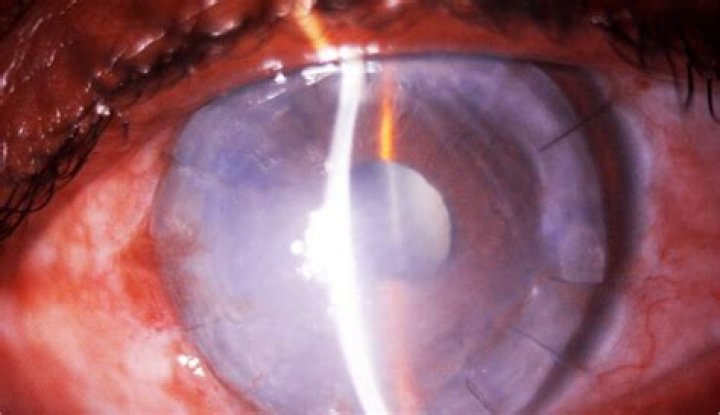 What is Pythium keratitis?