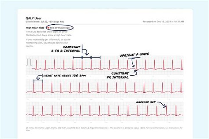 What is SVT on ECG?