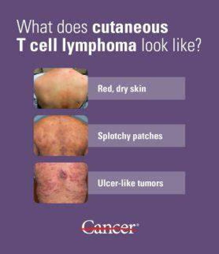 What is T-cell lymphoma code?