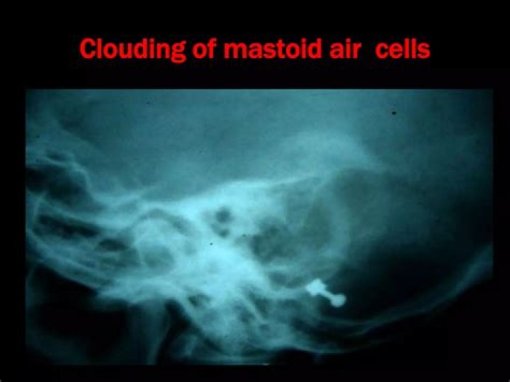 What is the mastoid air cells?