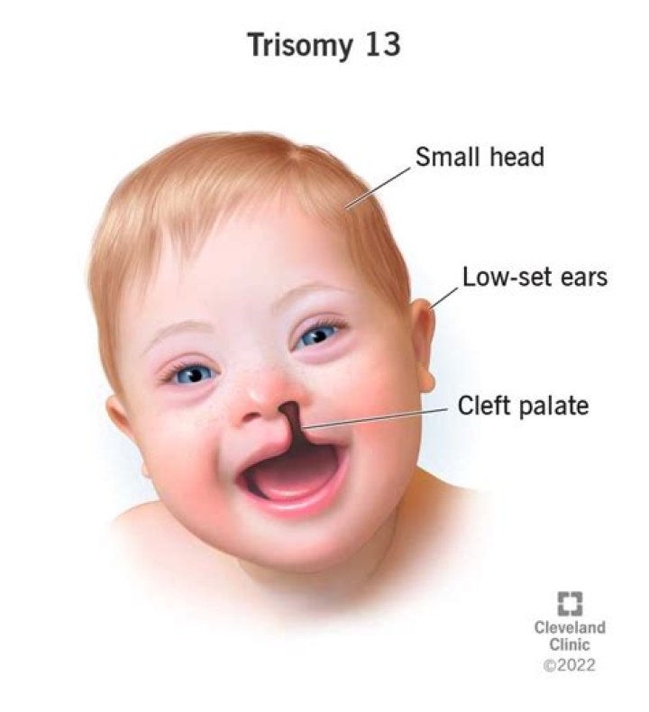What is the normal range of trisomy 13?