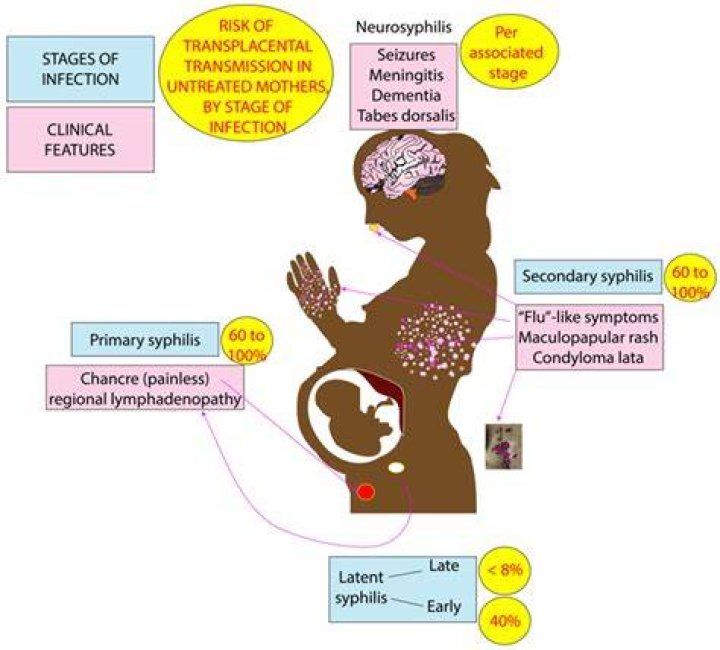 What is the treatment for neurosyphilis?