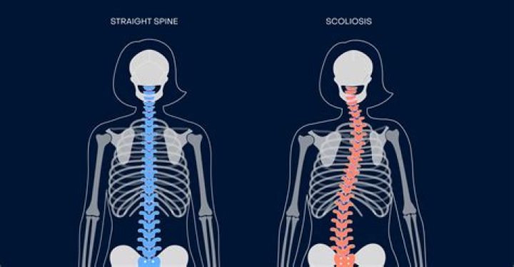 What radiologist should know about scoliosis?