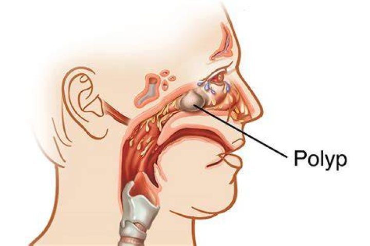 When should a cervical polyp be removed?