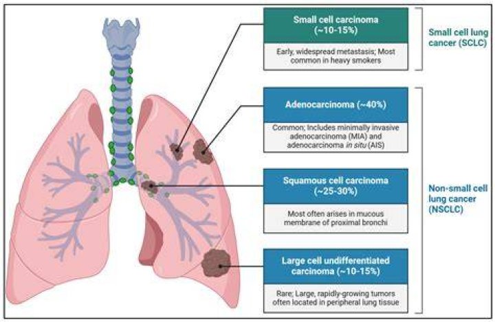 Which paraneoplastic syndrome is commonly associated with small cell carcinoma of the lung?