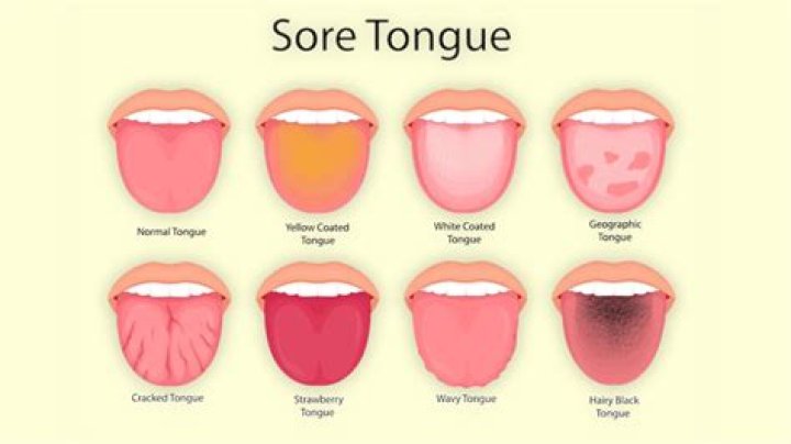 Why do I have a dump on my tongue?