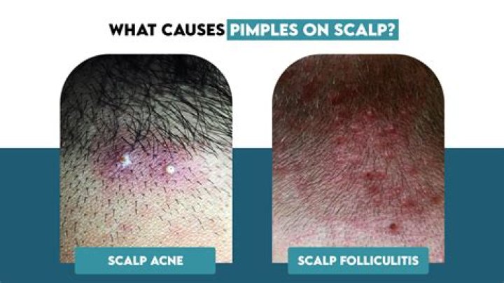 Why do I have bumps after a haircut?