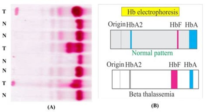 Why is HbA2 high in thalassemia?