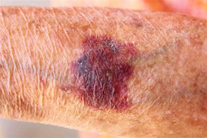 Why is my skin turning red as I get older?