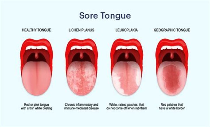Why is the side of my tongue hurting me?
